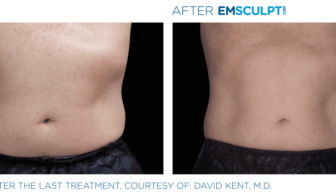 How Long Does NEO Emsculpt Last?