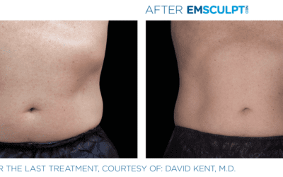 How Long Does NEO Emsculpt Last?