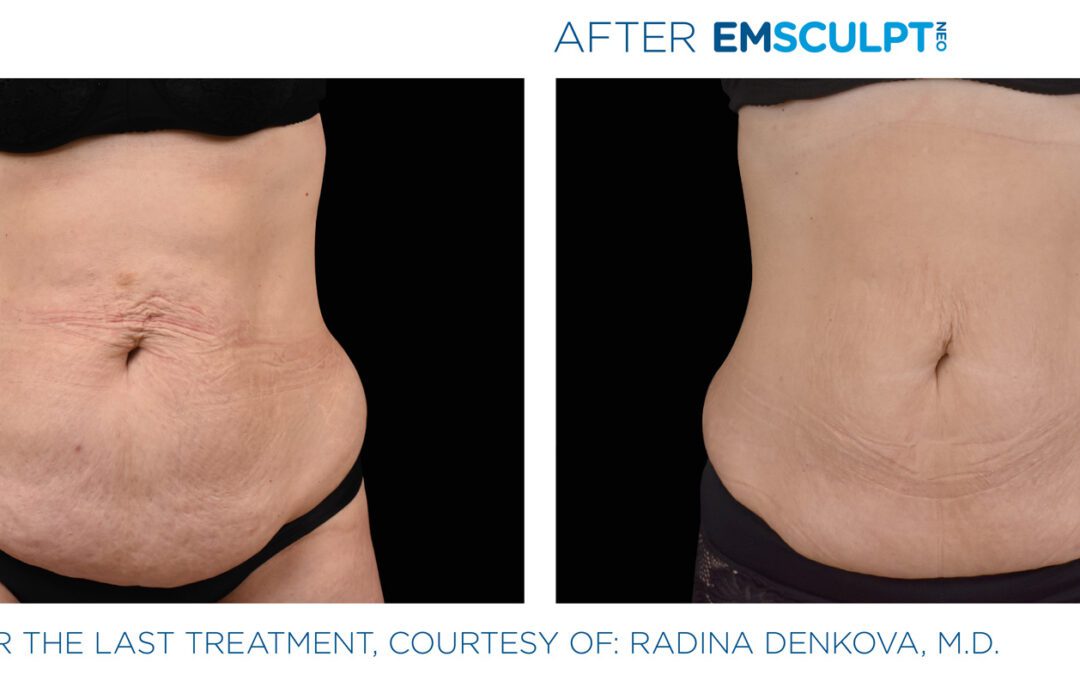Is Emsculpt NEO Healthy?
