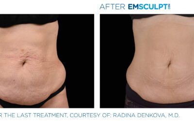 Is Emsculpt NEO Healthy?