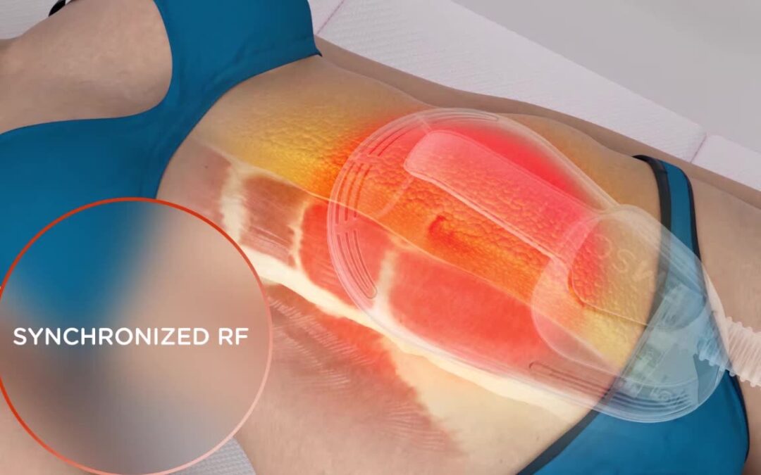 How Painful Is Emsculpt Neo?