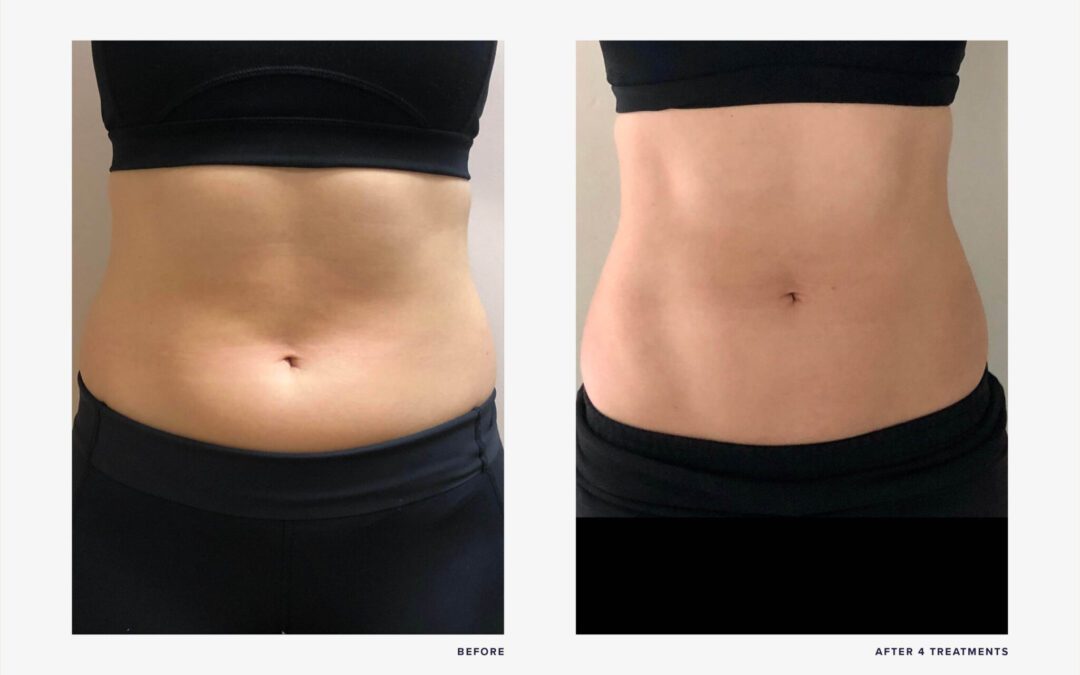 Does Emsculpt Neo Tighten Skin?